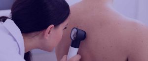 Câncer de pele: quais são os sintomas e como se prevenir?