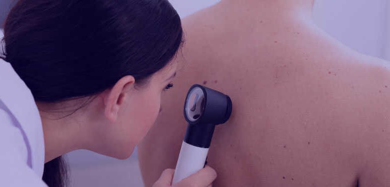 Câncer de pele: quais são os sintomas e como se prevenir?